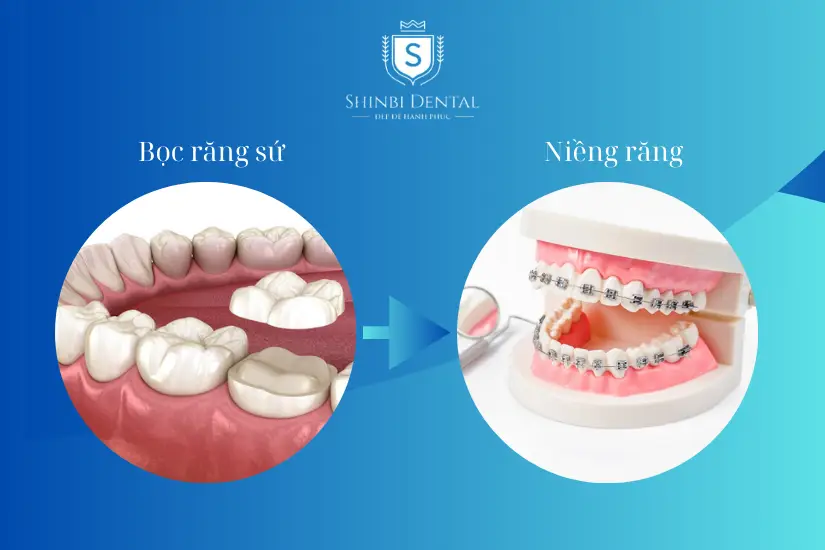 Nên làm răng sứ hay niềng răng