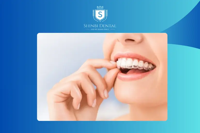 Niềng răng trong suốt có nhiều ưu điểm Niềng răng trong suốt có nhiều ưu điểm