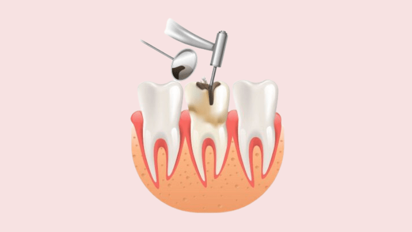 Quy trình điều trị tủy răng Quy trình điều trị tủy răng