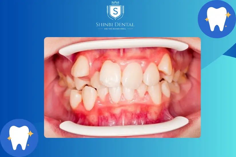 Không bọc răng sứ cho răng chen chúc Không bọc răng sứ cho răng chen chúc