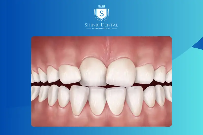 Răng lộn xộn nhẹ mới nên bọc răng sứ Răng lộn xộn nhẹ mới nên bọc răng sứ