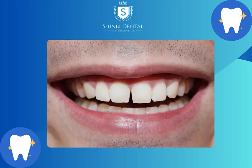 Răng thưa nhẹ nên bọc sứ Răng thưa nhẹ nên bọc sứ