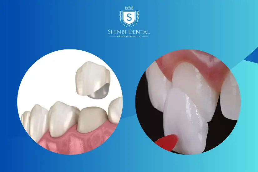 Sự khác biệt giữa bọc sứ và dán sứ về độ bền Sự khác biệt giữa bọc sứ và dán sứ về độ bền