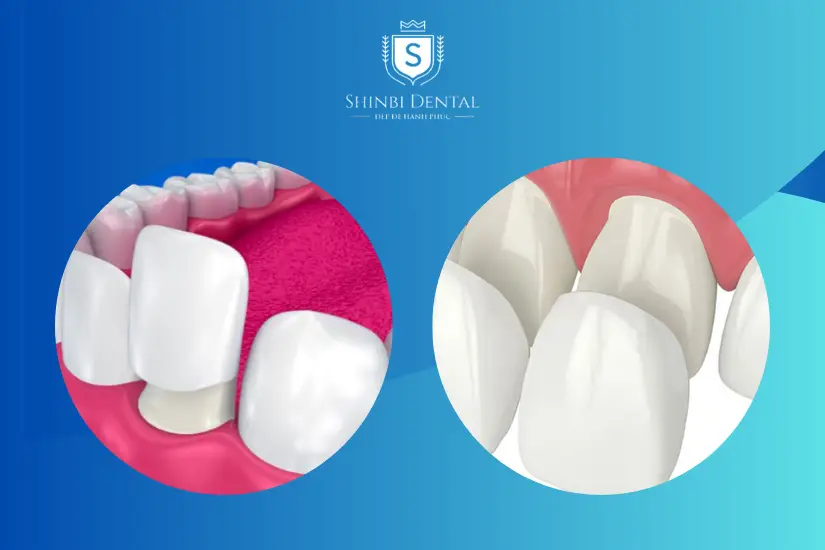 Sự khác biệt giữa bọc sứ và dán sứ về khớp cắn Sự khác biệt giữa bọc sứ và dán sứ về khớp cắn