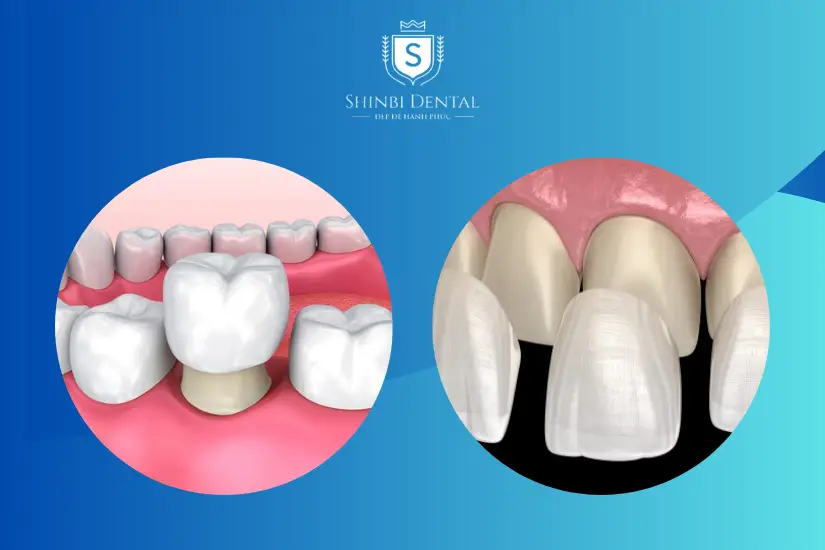Sự khác biệt giữa bọc sứ và dán sứ về mặt kỹ thuật Sự khác biệt giữa bọc sứ và dán sứ về mặt kỹ thuật