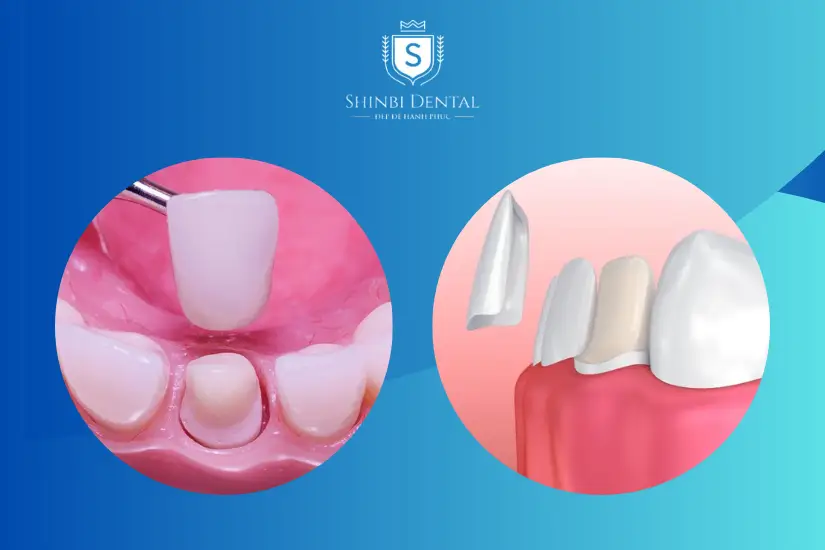 Bọc răng và dán răng sứ khác nha về màu sắc của răng bên cạnh Bọc răng và dán răng sứ khác nha về màu sắc của răng bên cạnh