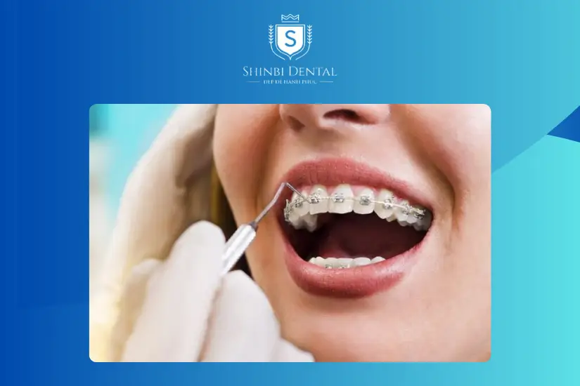 Nha khoa Shinbi là một trong những địa chỉ niềng răng uy tín ở Hà Nội