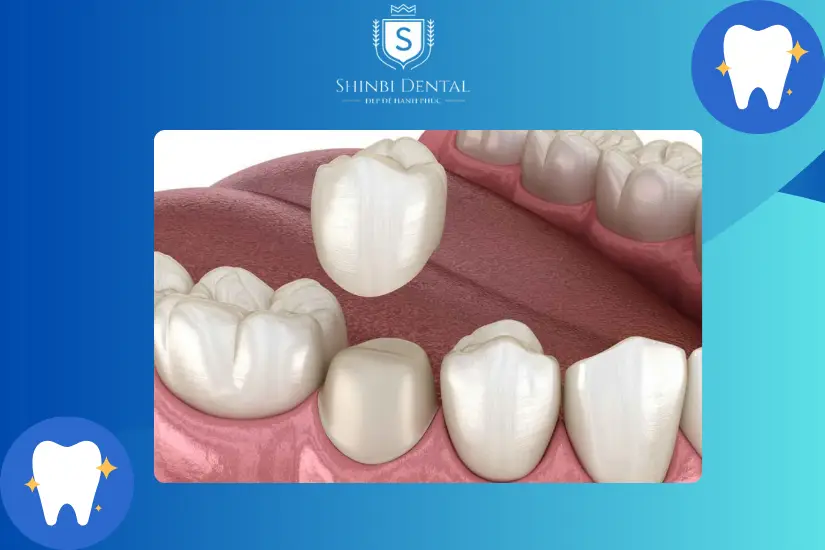 Thử mão răng sứ Thử mão răng sứ