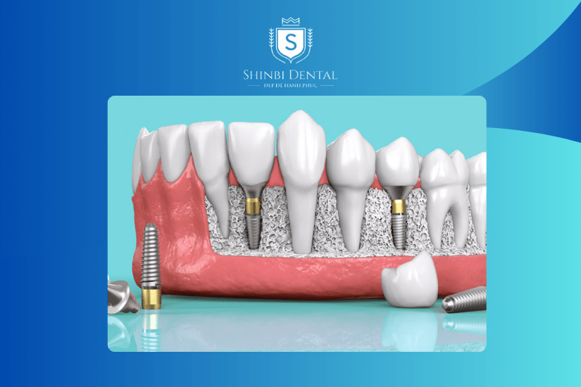 Tiêu chí để chọn cơ sở trồng răng Implant ở Hải Phòng chất lượng