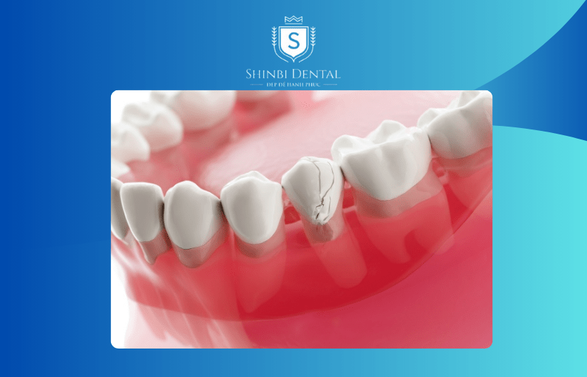 Tình trạng răng miệng ảnh hưởng tới giá bọc răng sứ Tình trạng răng miệng ảnh hưởng tới giá bọc răng sứ