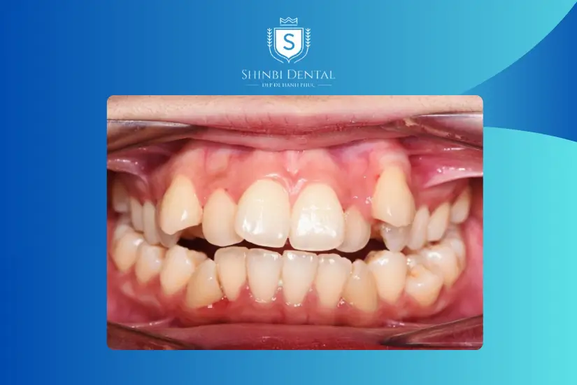 Tình trạng răng miệng ảnh hưởng tới chi phí niềng răng Tình trạng răng miệng ảnh hưởng tới chi phí niềng răng