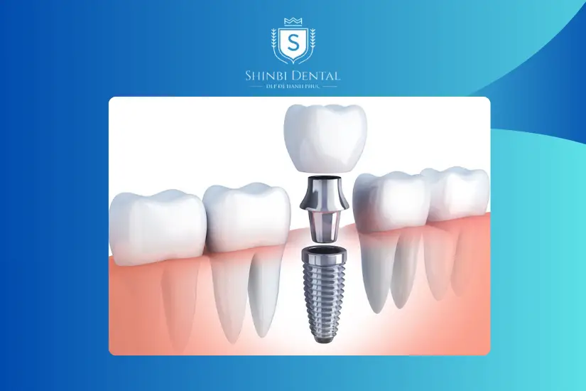 Phục hình thẩm mỹ bằng trồng răng Phục hình thẩm mỹ bằng trồng răng