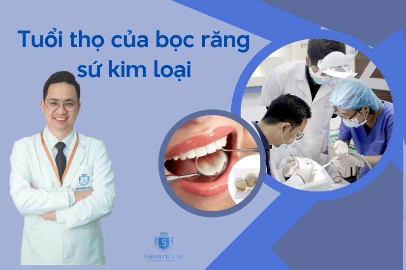 bọc răng sứ kim loại được bao lâu