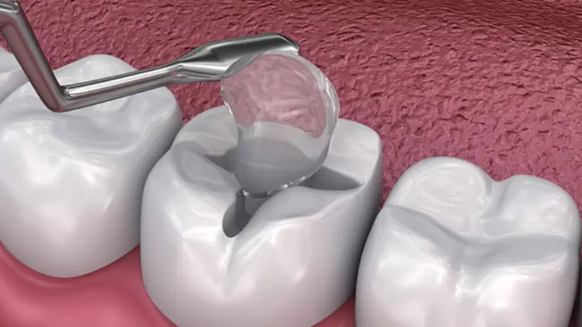 Các loại vật liệu hàn răng Các loại vật liệu hàn răng