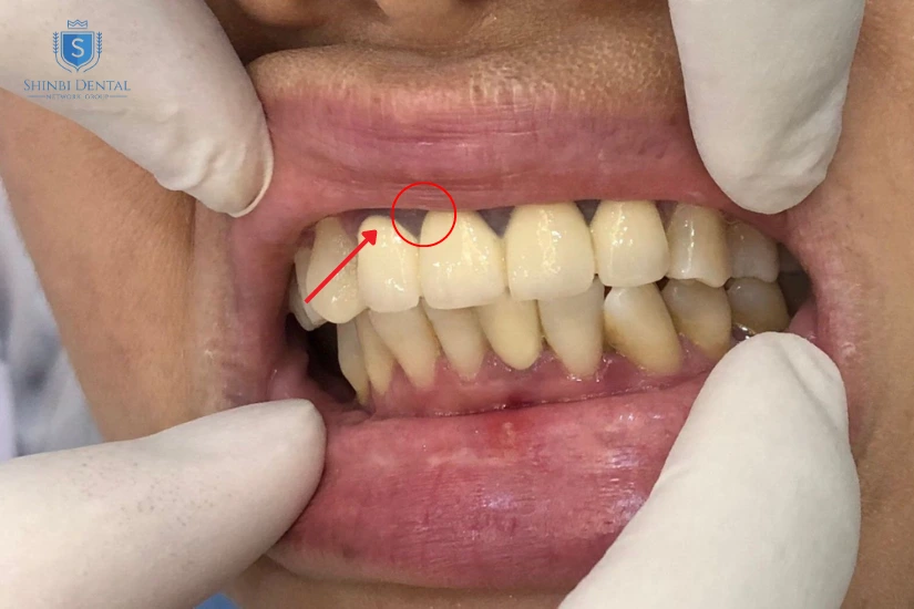 Viền nướu (lợi) đổi màu