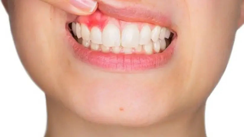 Các yếu tố nguy cơ gây bệnh nha chu Các yếu tố nguy cơ gây bệnh nha chu