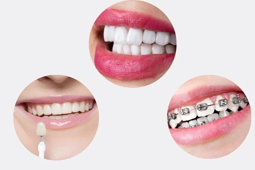 So sánh bọc răng sứ với niềng răng, mặt dán sứ