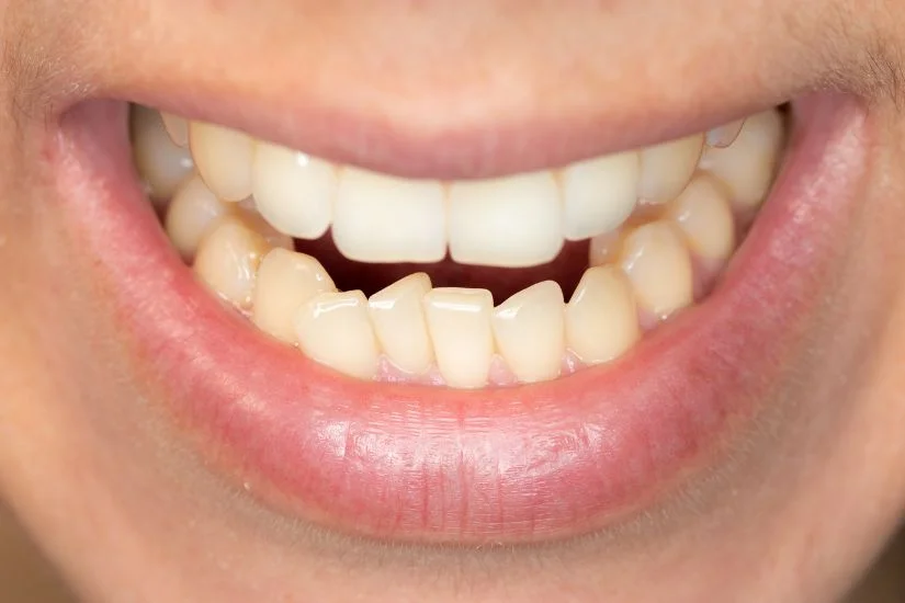 Bọc răng sứ cho răng lệch lạc giúp khắc phục vấn đề khớp cắn