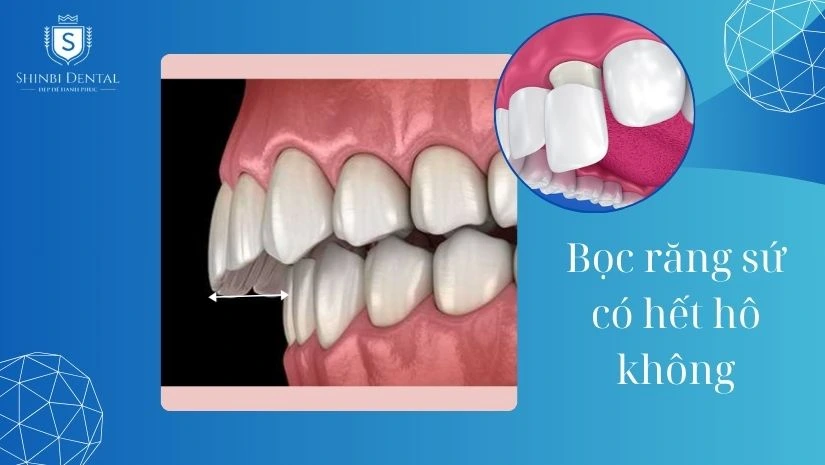 Bọc răng sứ có hết hô không? 4 Biện pháp khắc phục