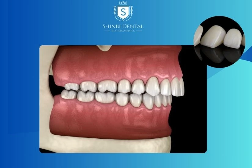 Bọc răng sứ chỉ phù hợp cho các trường hợp hô nhẹ
