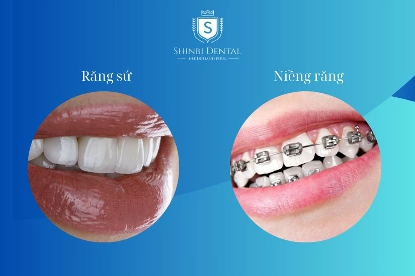 Răng hô nên niềng hay bọc sứ