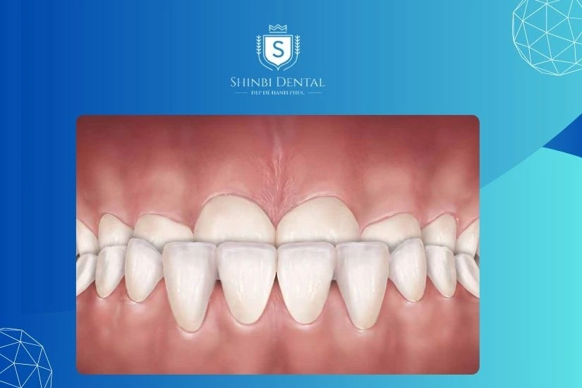 Bọc răng sứ có hết móm không