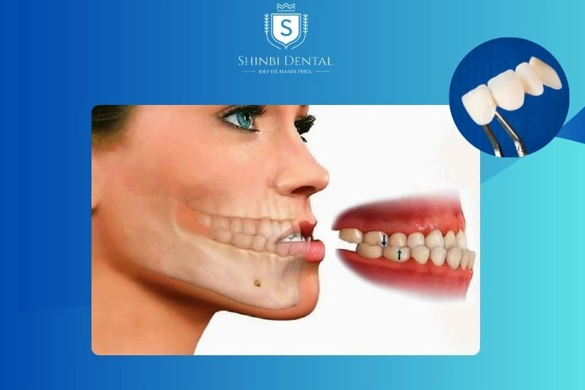 Móm do răng hay do xương hàm sẽ có cách điều trị khác nhau