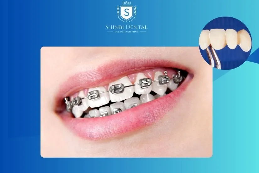 Bọc răng sứ niềng được ở một số trường hợp