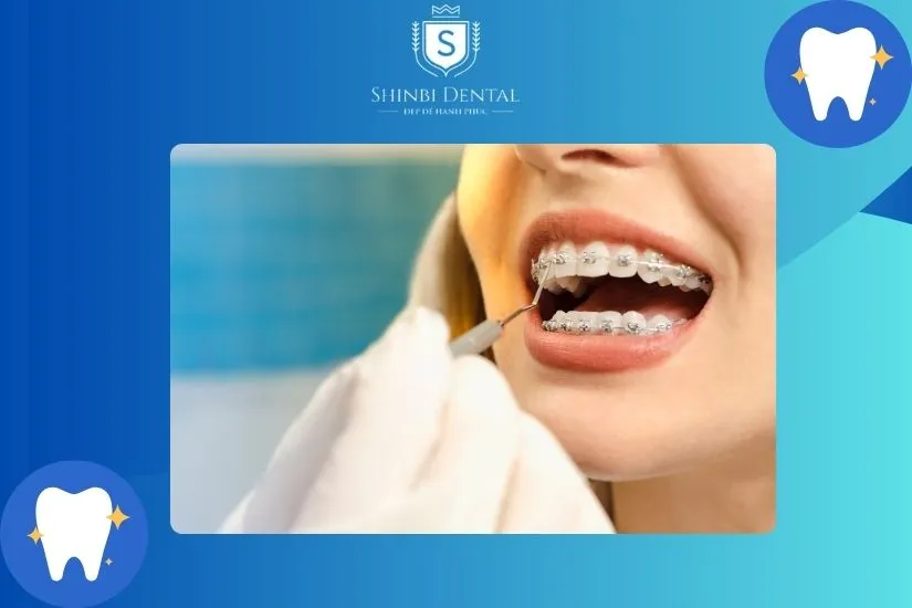 Răng vẫn còn khả năng dịch chuyển là niềng được