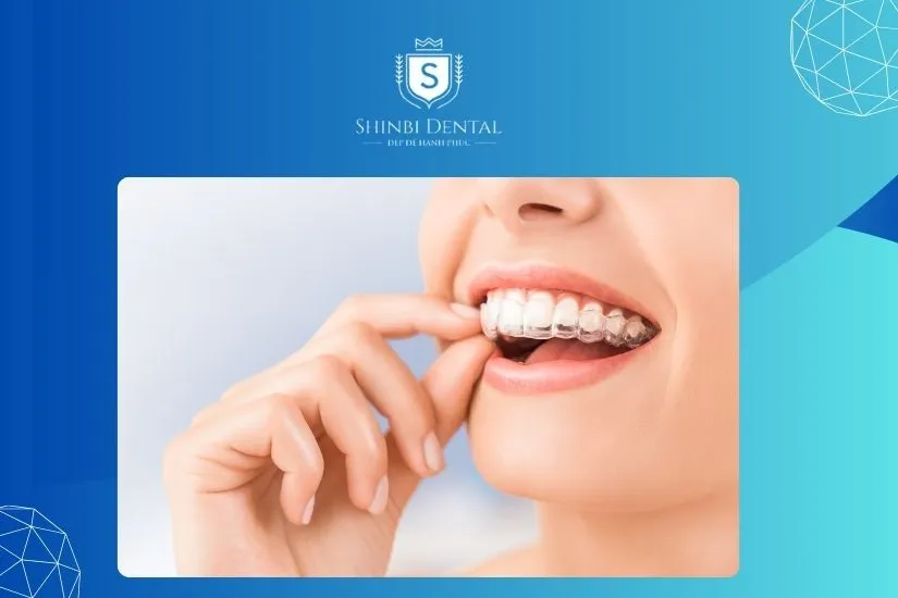 Niềng răng không mắc cài Invisalign