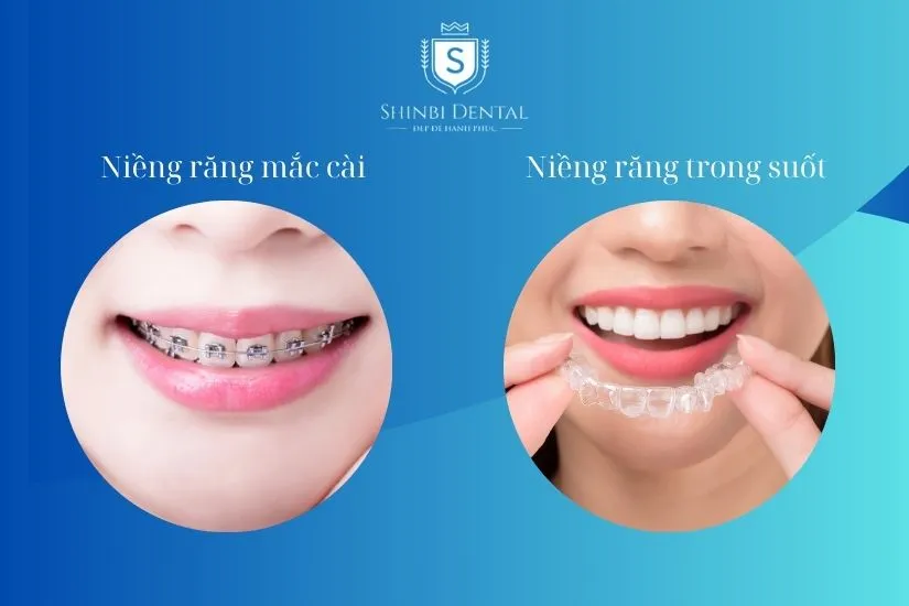 Các phương pháp niềng răng sau khi bọc sứ