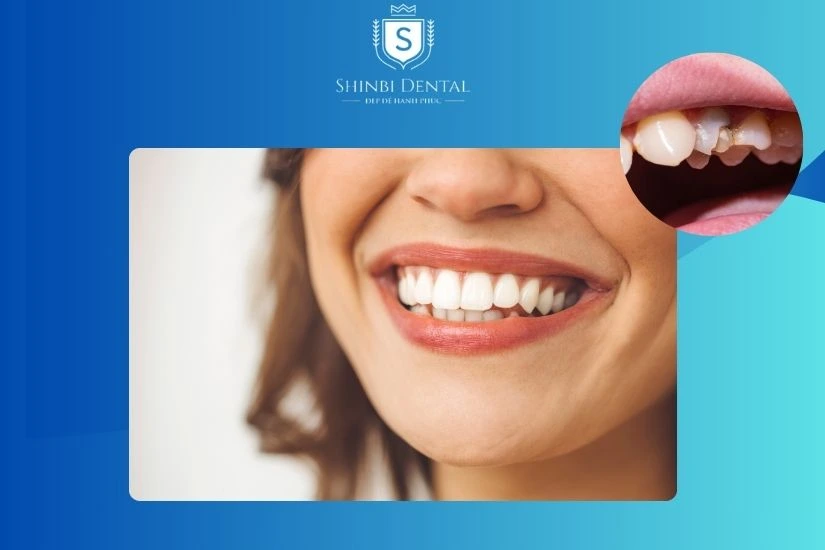 Bọc sứ giúp bảo vệ răng tự nhiên Bọc sứ giúp bảo vệ răng tự nhiên