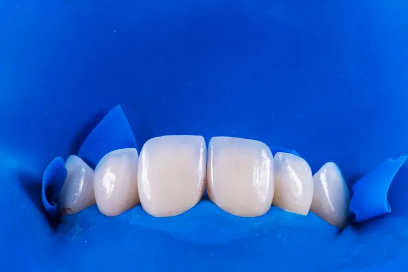 Chất liệu răng sứ Veneer ảnh hưởng tới chi phí