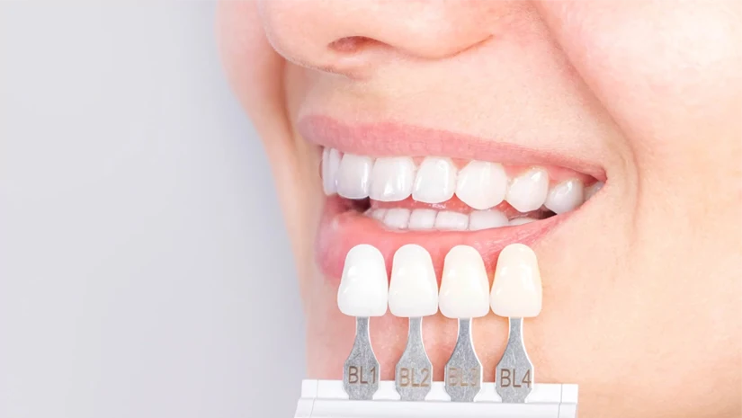 Bọc sứ răng cửa Bọc sứ răng cửa