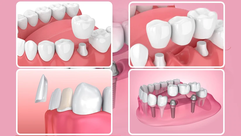 4 cách bọc răng sứ thẩm mỹ phổ biến nhất hiện nay