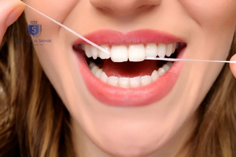 Cách kéo dài độ bền khi dán răng sứ veneer