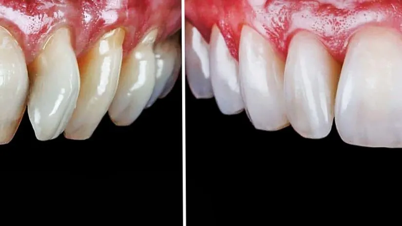 Review dán sứ veneer bệnh viện Răng Hàm Mặt chi tiết