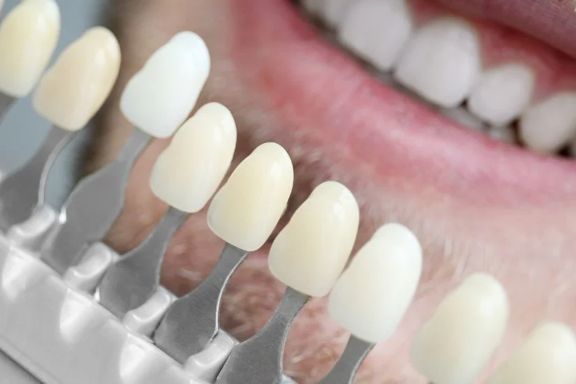 Giá dán sứ Veneer bao nhiêu tiền?