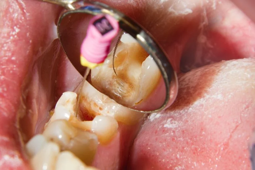 Chi phí bọc răng sứ tùy theo từng loại Chi phí bọc răng sứ tùy theo từng loại