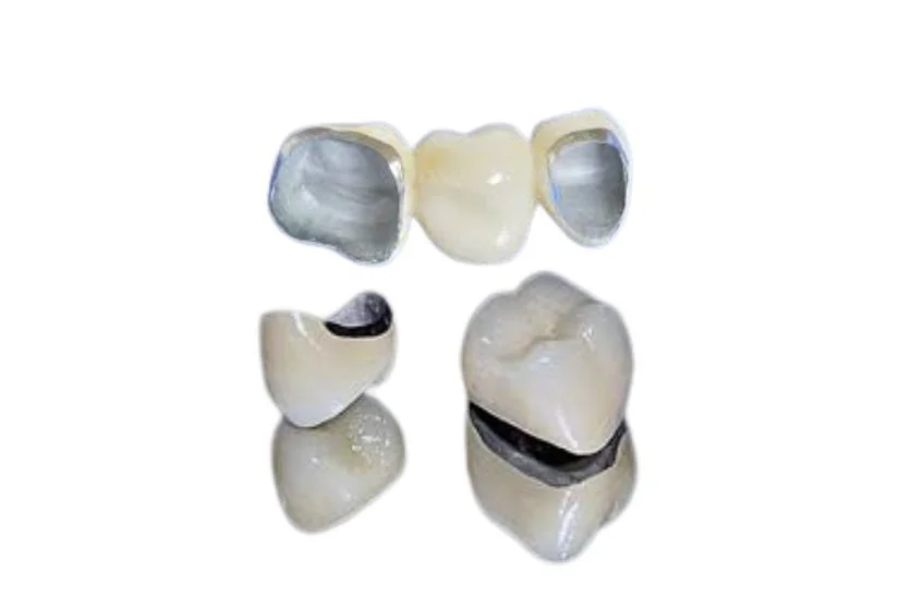 Bọc răng sứ kim loại có mức giá thấp nhất Bọc răng sứ kim loại có mức giá thấp nhất