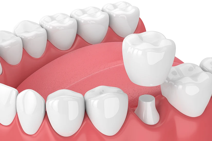 cách bọc răng sứ bằng làm mão răng