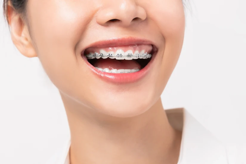 Nên niềng răng trước hay trồng răng Implant trước? Nên niềng răng trước hay trồng răng Implant trước?