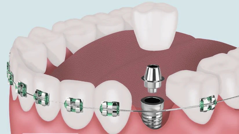 trồng răng imlant có niềng răng được không