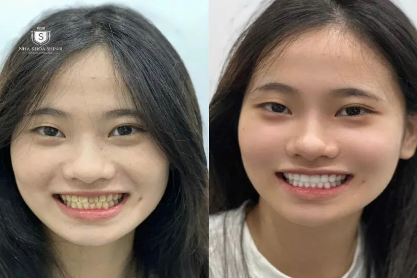 Tính thẩm mỹ sau khi làm dán sứ veneer siêu mỏng?