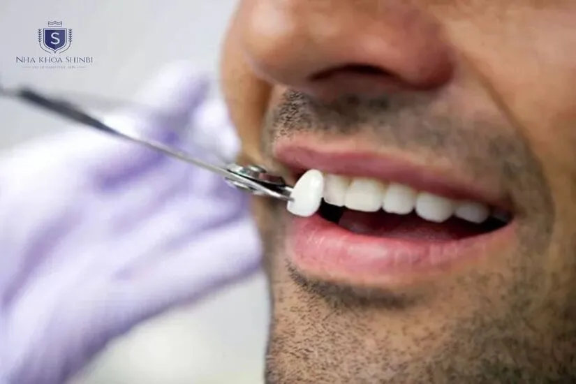 Có nên dán sứ veneer răng cửa thưa không? Có nên dán sứ veneer răng cửa thưa không?