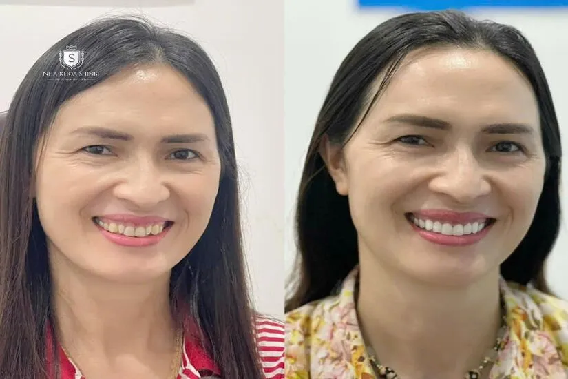 Tính thẩm mỹ sau khi làm dán sứ veneer siêu mỏng?