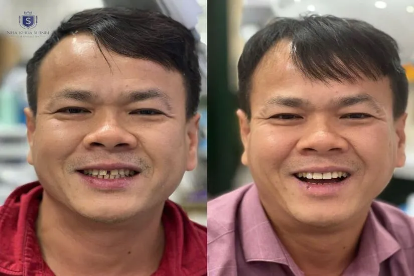 Tính thẩm mỹ sau khi làm dán sứ veneer siêu mỏng?