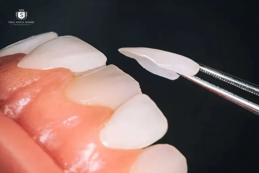 Mặt dán sứ Veneer siêu mỏng có cần mài răng hay không?