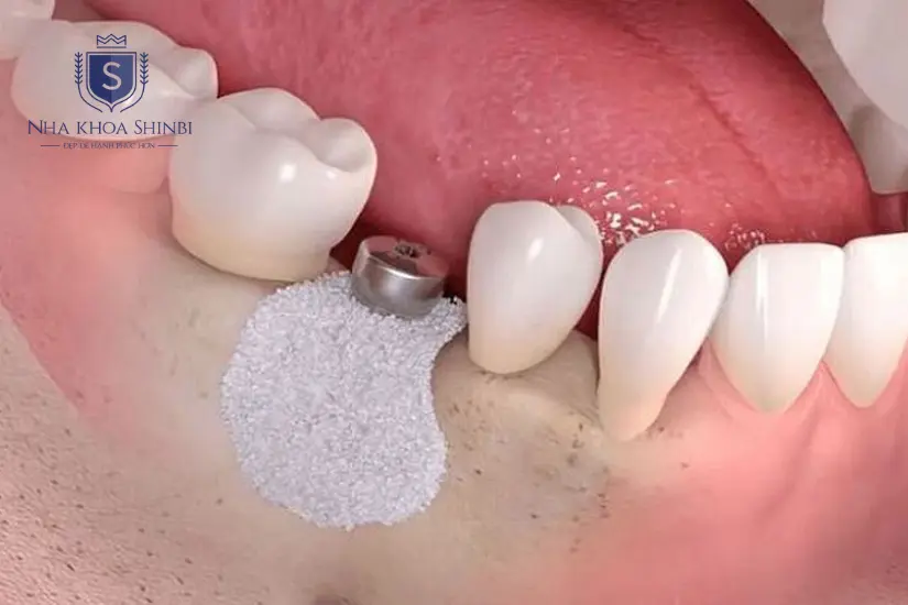 Cấy ghép xương ổ răng bao lâu thì lành?