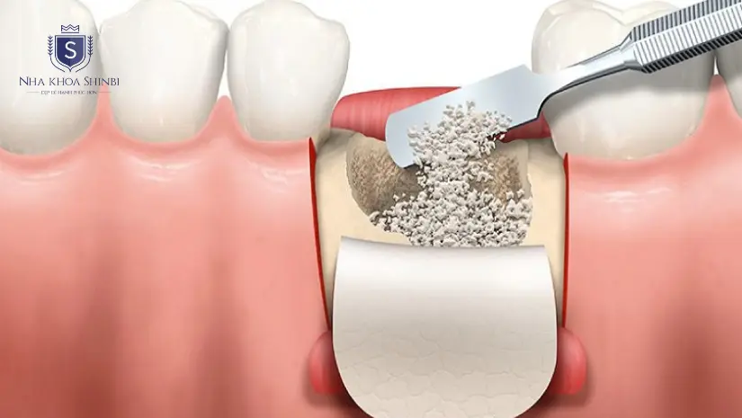 Cấy ghép xương ổ răng là như thế nào, khi nào cần thực hiện?